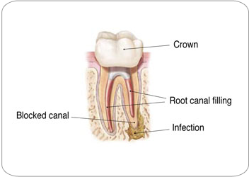 Endodontic Retreatment - Options|Strongsville, OH Endodontist