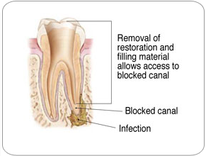 Endodontic Retreatment - Removal of Restoration|Strongsville, OH Endodontist
